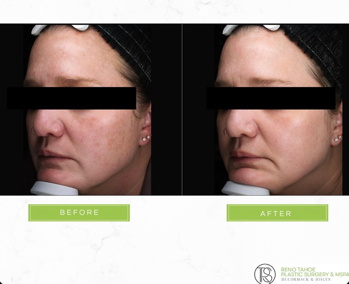 Day 4 | Lift & Laser Day