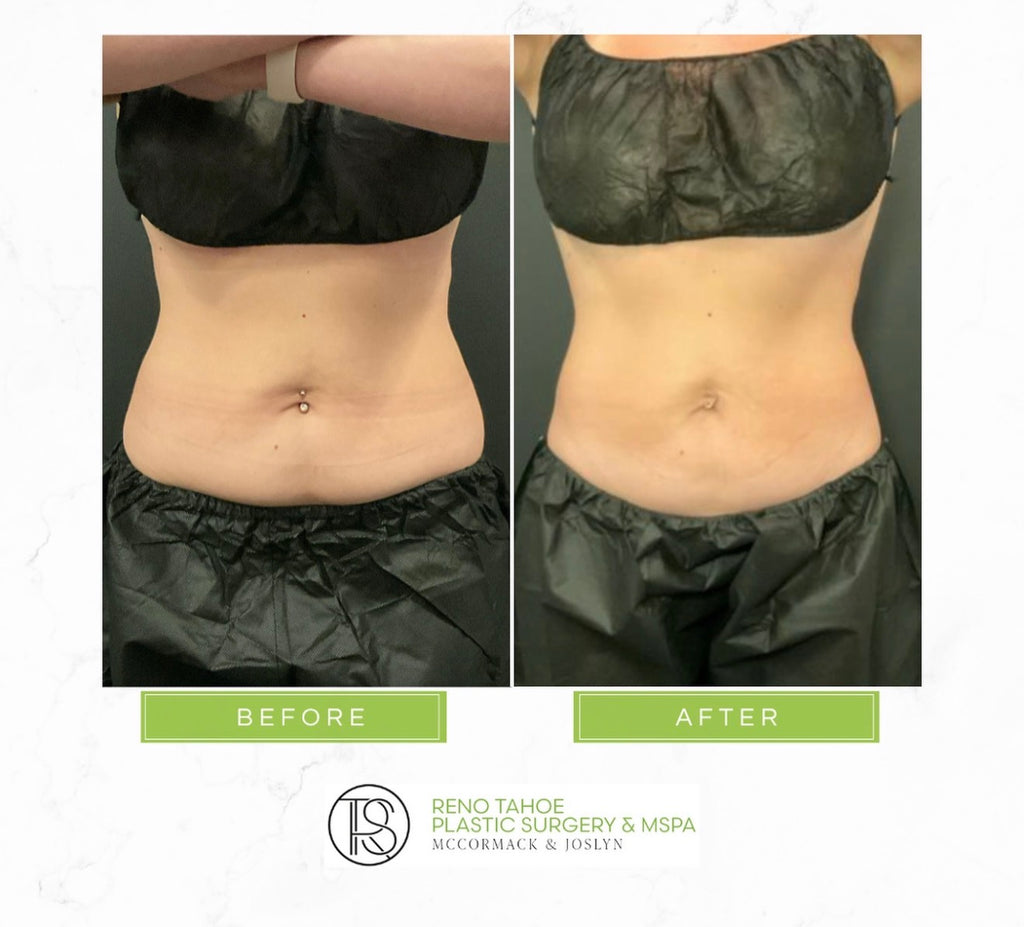 Day 8 | CoolSculpt & Tone Day