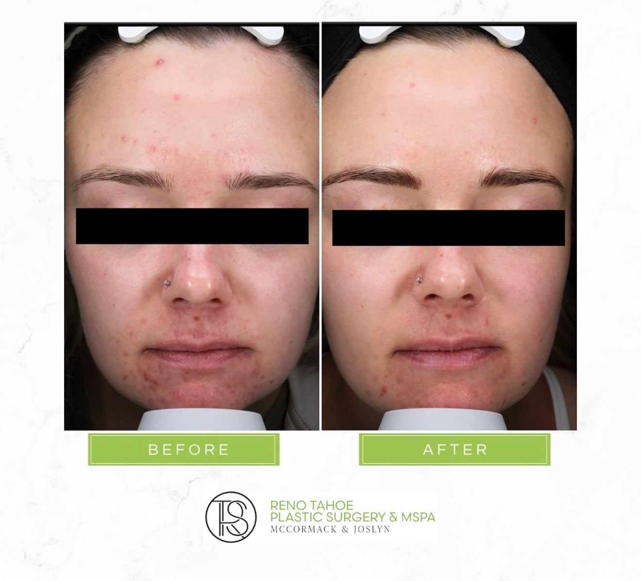 Day 10 | SkinPen Glow-Up